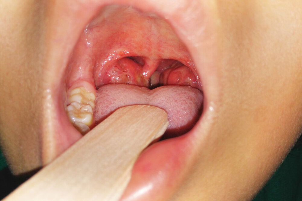 std white spots on tonsils