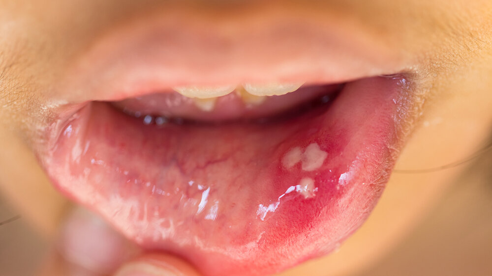 std in mouth