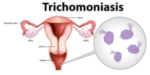 reasons why trichomoniasis won't go away