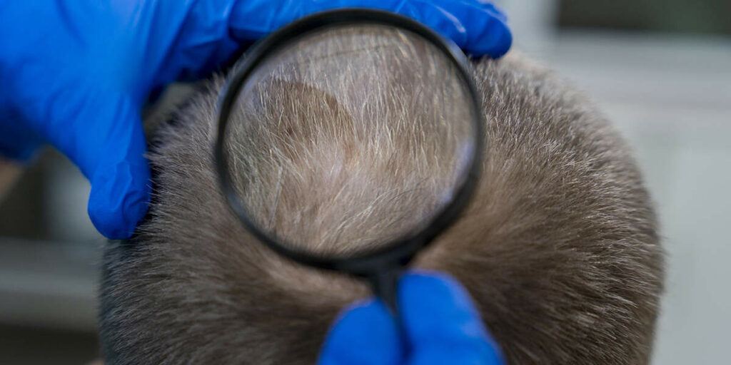 will my hair grow back after syphilis treatment