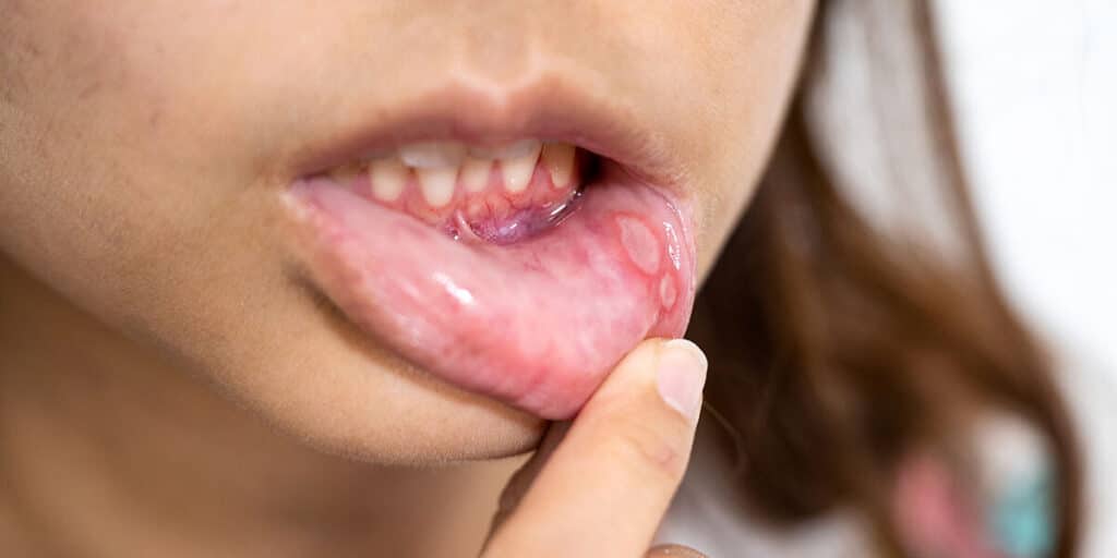 are canker sores an std